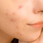 como-quitar-los-granitos-de-la-cara