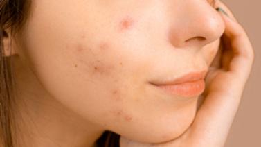 como-quitar-los-granitos-de-la-cara