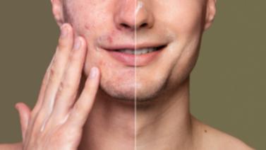 crema-para-quitar-granos-al-instante